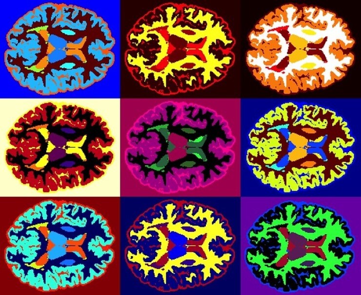 Axial MRI scans of a person with multiple sclerosis. 